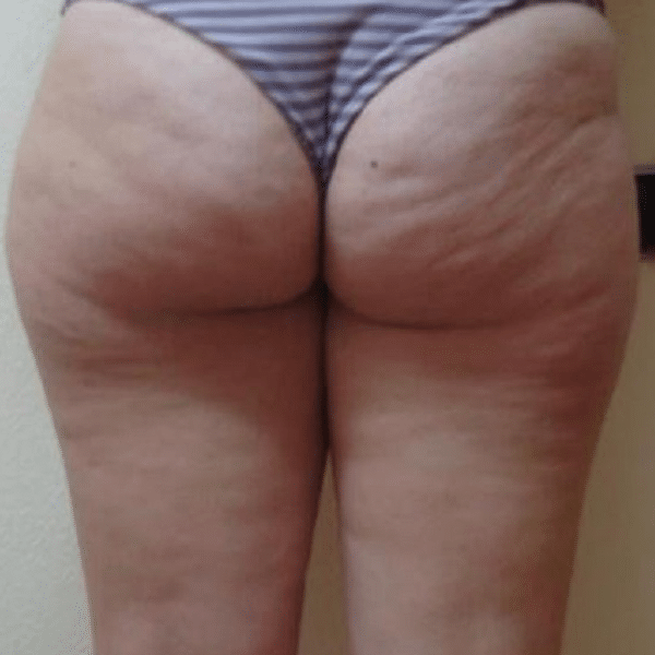 Cellulite-reduction-courtesy-of-Dr.-Mariola-Bellon,-Cenydiet-Clinic,-Spain-before600