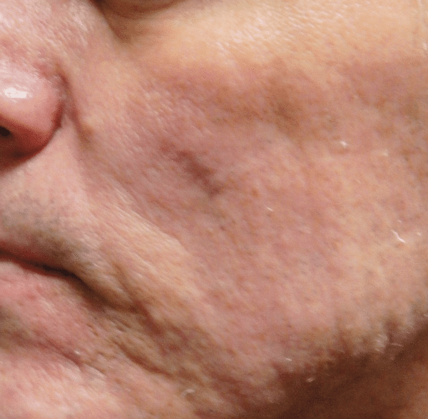 Skin-tightening-and-resurfacing-courtesy-of-Dr.-Mathew-Jafarzadeh-Australia-before-Intensif-treatments600px.png
