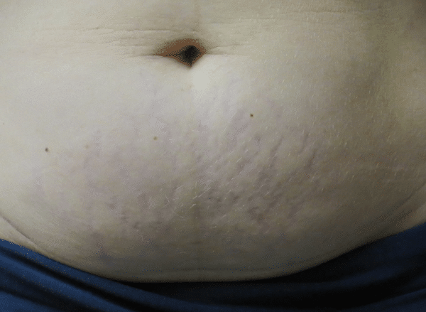 Stretchmarks-Courtesy-of-Dr.-Barolet-Canada-before-Intensif-treatment_600Px.png
