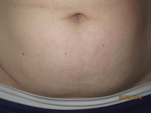 Stretchmarks-Courtesy-of-Dr.-Daniel-Barolet-Canada-after-Intensif-treatments_600px.png