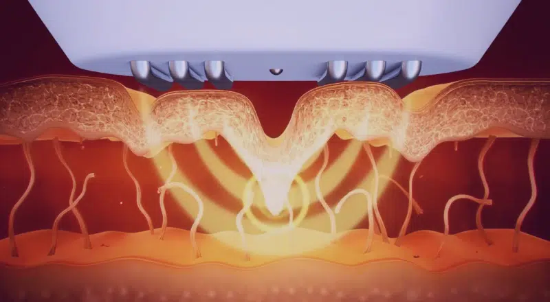 Science of Skin Tightening