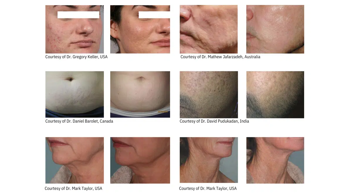 The Ultimate Microneedling Experience How EndyMed’s RF Reigns Supreme_Blog In-Article Graphic