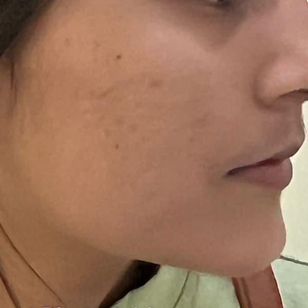 acne-s85-after