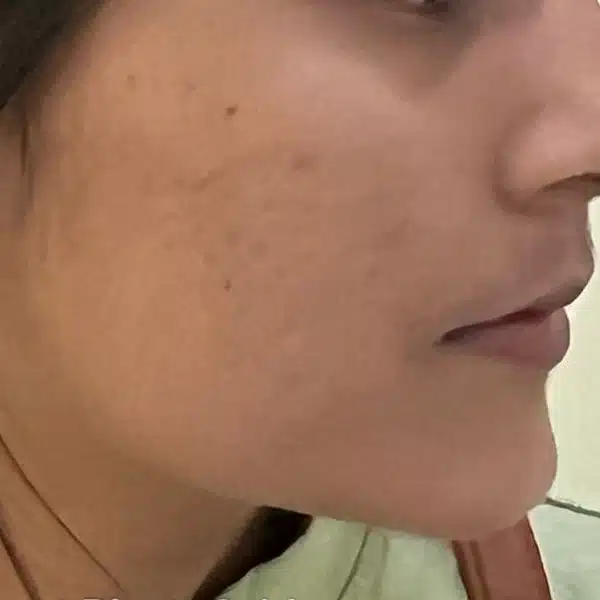 acne-s85-after