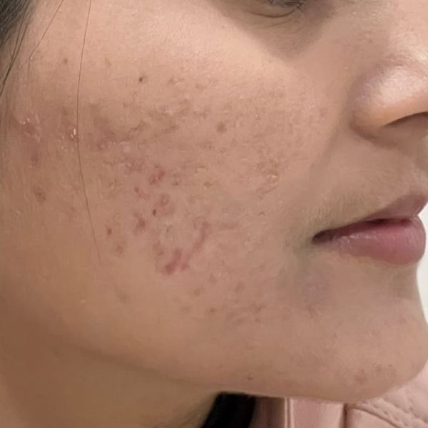 acne-s85-before