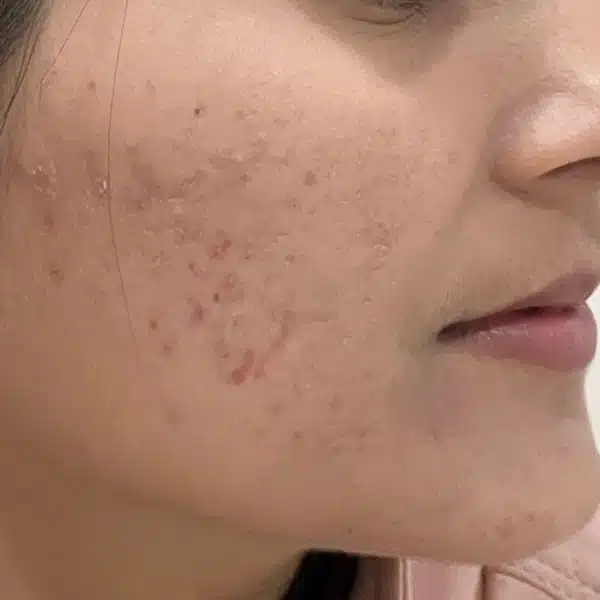 acne-s85-before