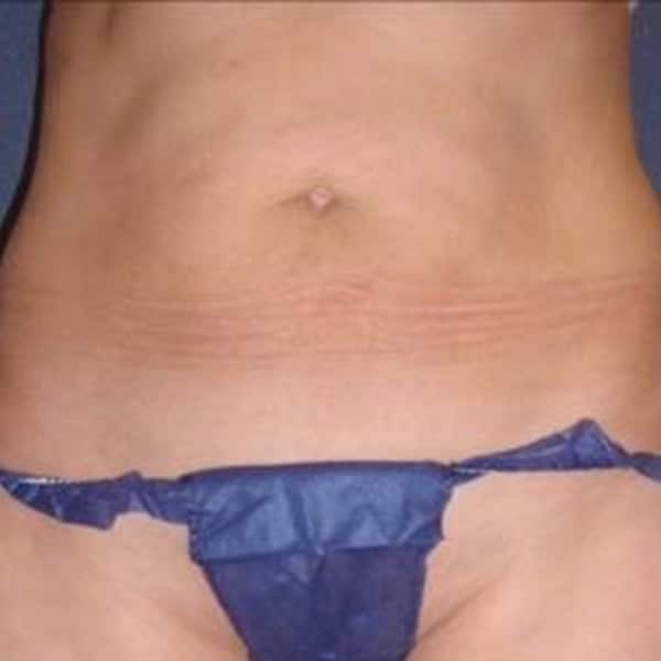 belly-s10-after
