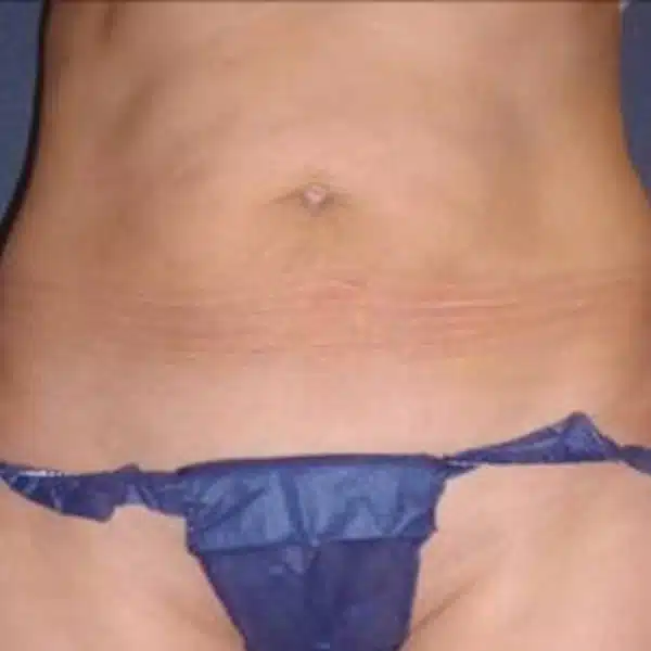 belly-s10-after