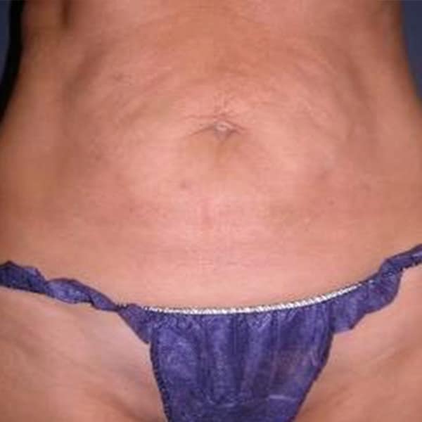 belly-s10-before