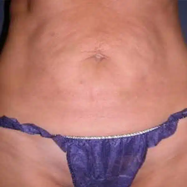 belly-s10-before