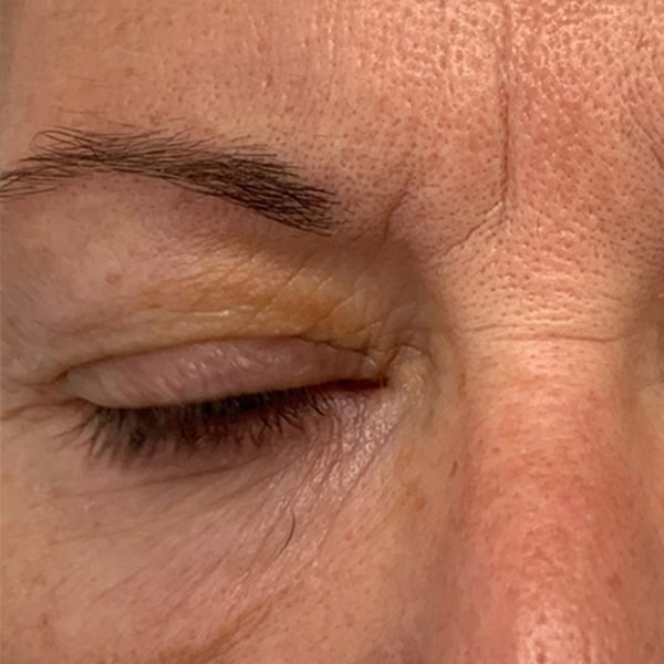 eye-s33-after