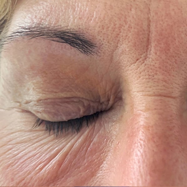 eye-s33-before