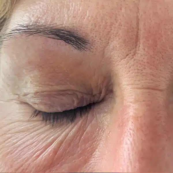 eye-s33-before