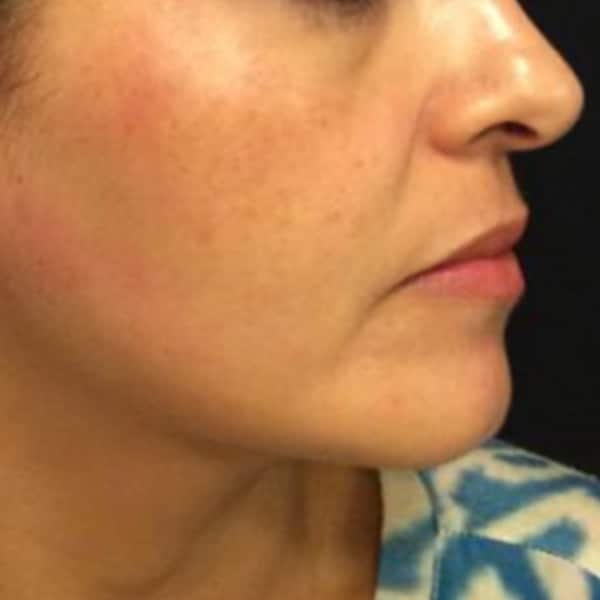 face-s60-after