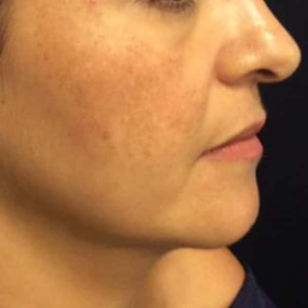 face-s60-before
