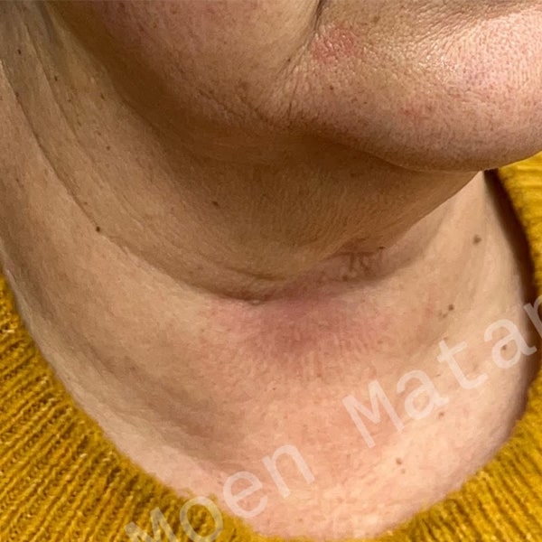 neck-s6-before