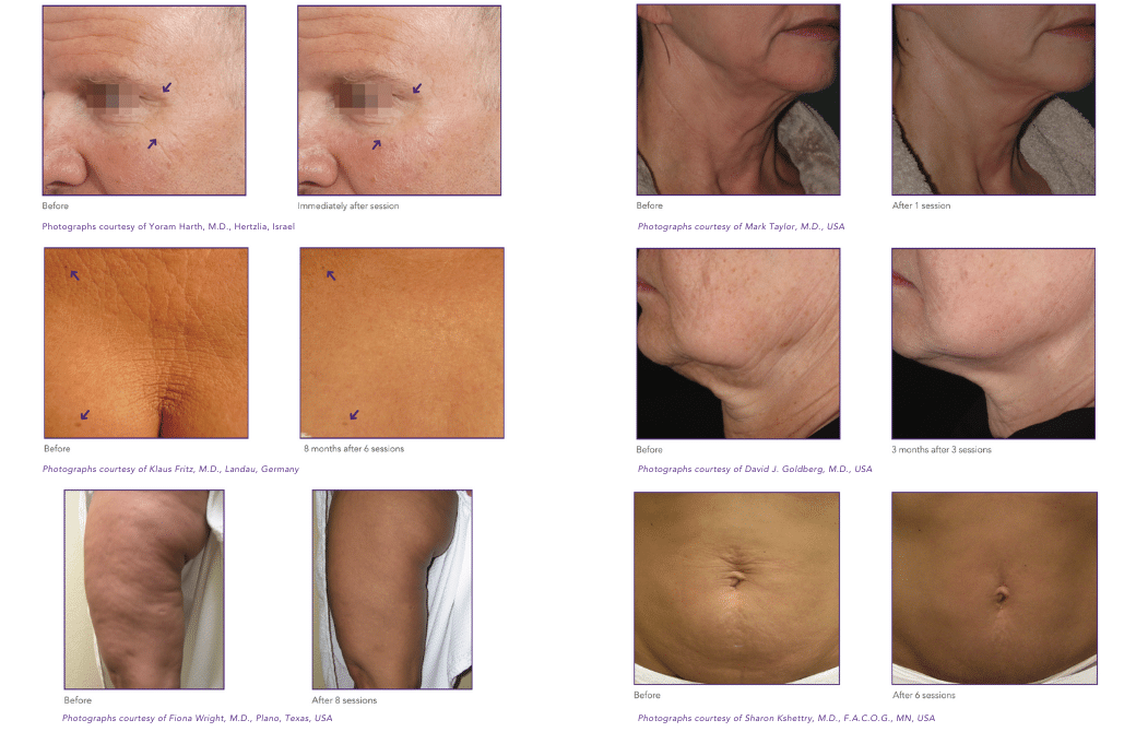 Best RF for Med Spa - before and after