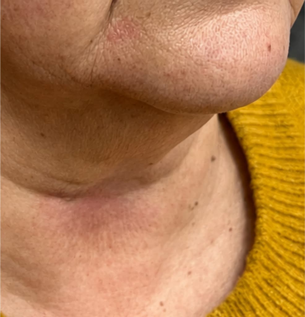 After: neck after